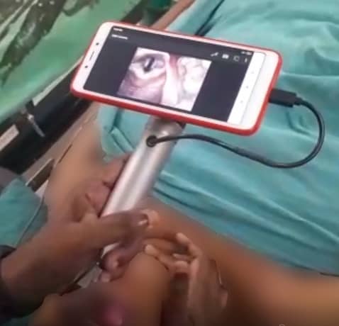 video laryngoscope